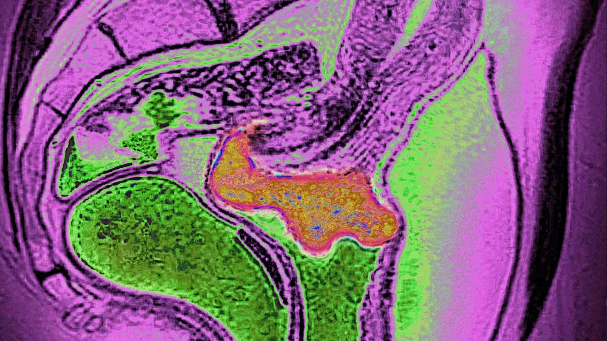 Cervical cancer visualized by sagittal MRI, papillomavirus infection is often the cause. 